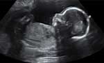 سونوگرافی بارداری | دکتر مژگان قدیری