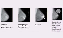 ماموگرافی می تواند ریسک بیماری قلبی را مشخص کند