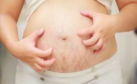 تغییرات پوستی در بارداری | دکتر شبنم وثوقی
