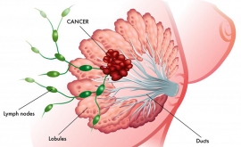بر اساس گفته محققین، سرطان سینه یک بیماری واحد نیست