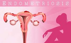 بارداری با اندومتریوز | دکتر فاطمه محرابی