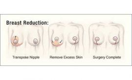 جراحی کوچک کردن سینه