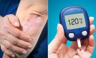 ارتباط بیماری پوستی پسوریازیس و ریسک ابتلا به دیابت