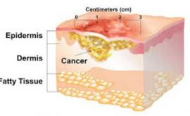 درمان سرطان پوست غیر ملانوم | دکتر علیرضا محبوبیان فر