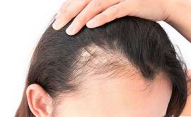 ریزش مو زنانه و درمان آن