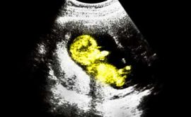 سونوگرافی جنین چیست؟
