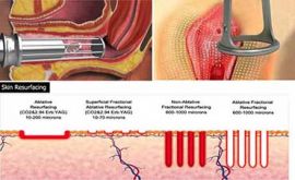 جوانسازی واژن با RF | دکتر پروانه سهامی