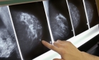 نرخ انجام ماموگرافی بعد از این که خانم ها از ریسک Overdiagnosis (تشخیص اشتباه) مطلع شوند، کاهش می یابد