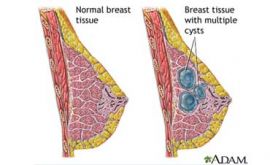بیماری های پستان | دکتر ژیلا غفوریان